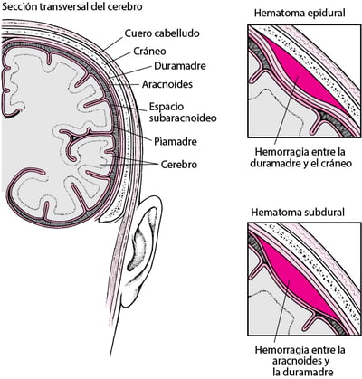 Acumulación de sangre en el encéfalo