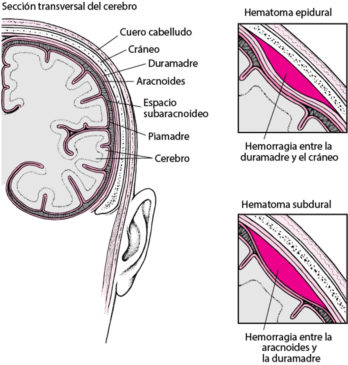 Bolsas de sangre en el encéfalo