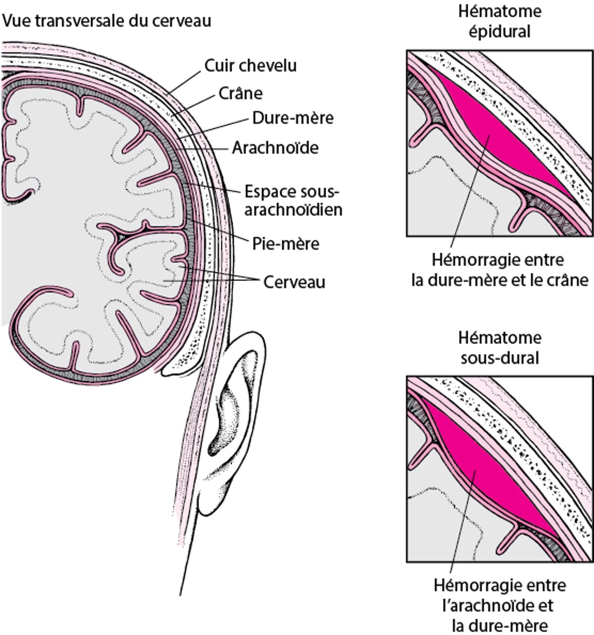 Poches de sang dans le cerveau