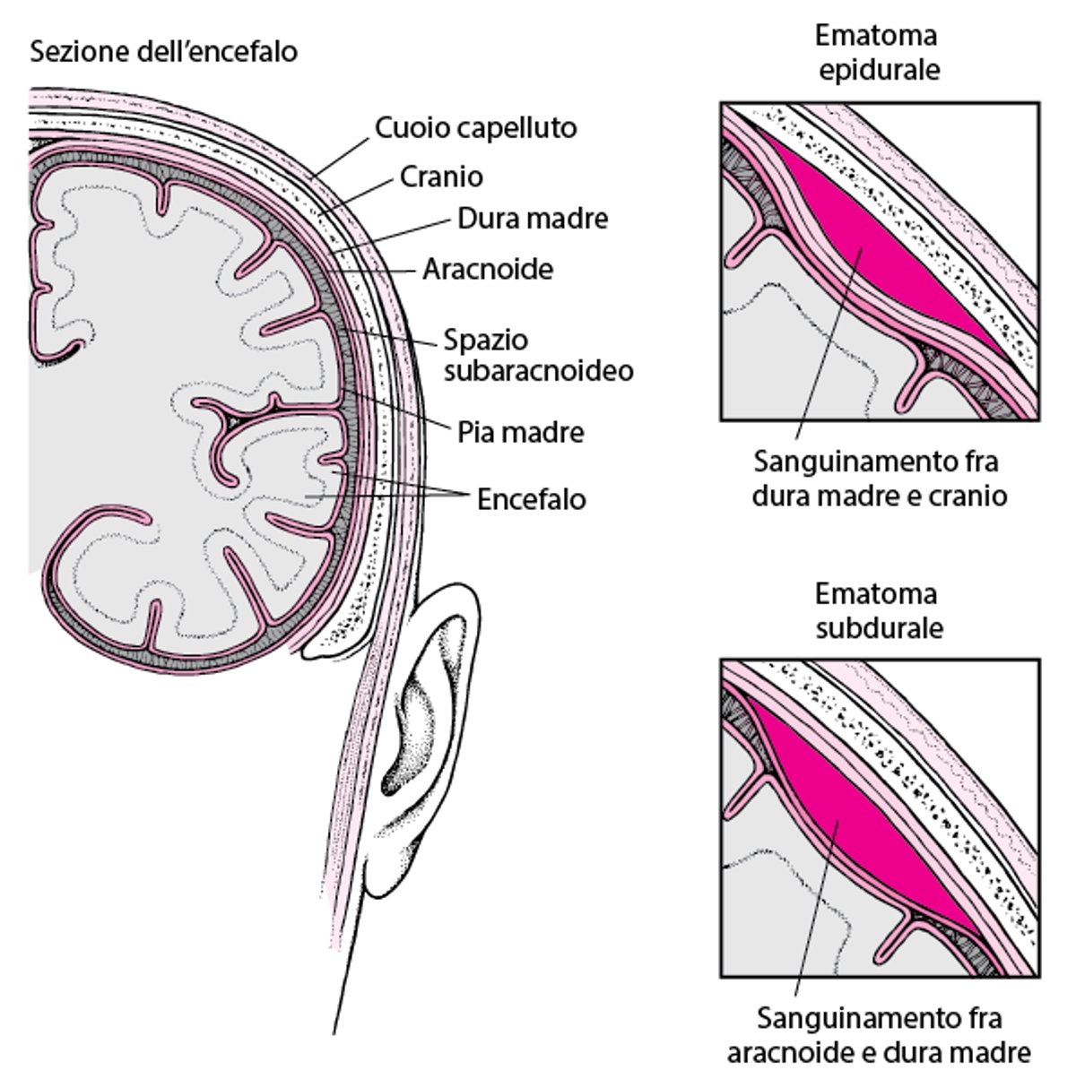 Sacche di sangue nel cervello