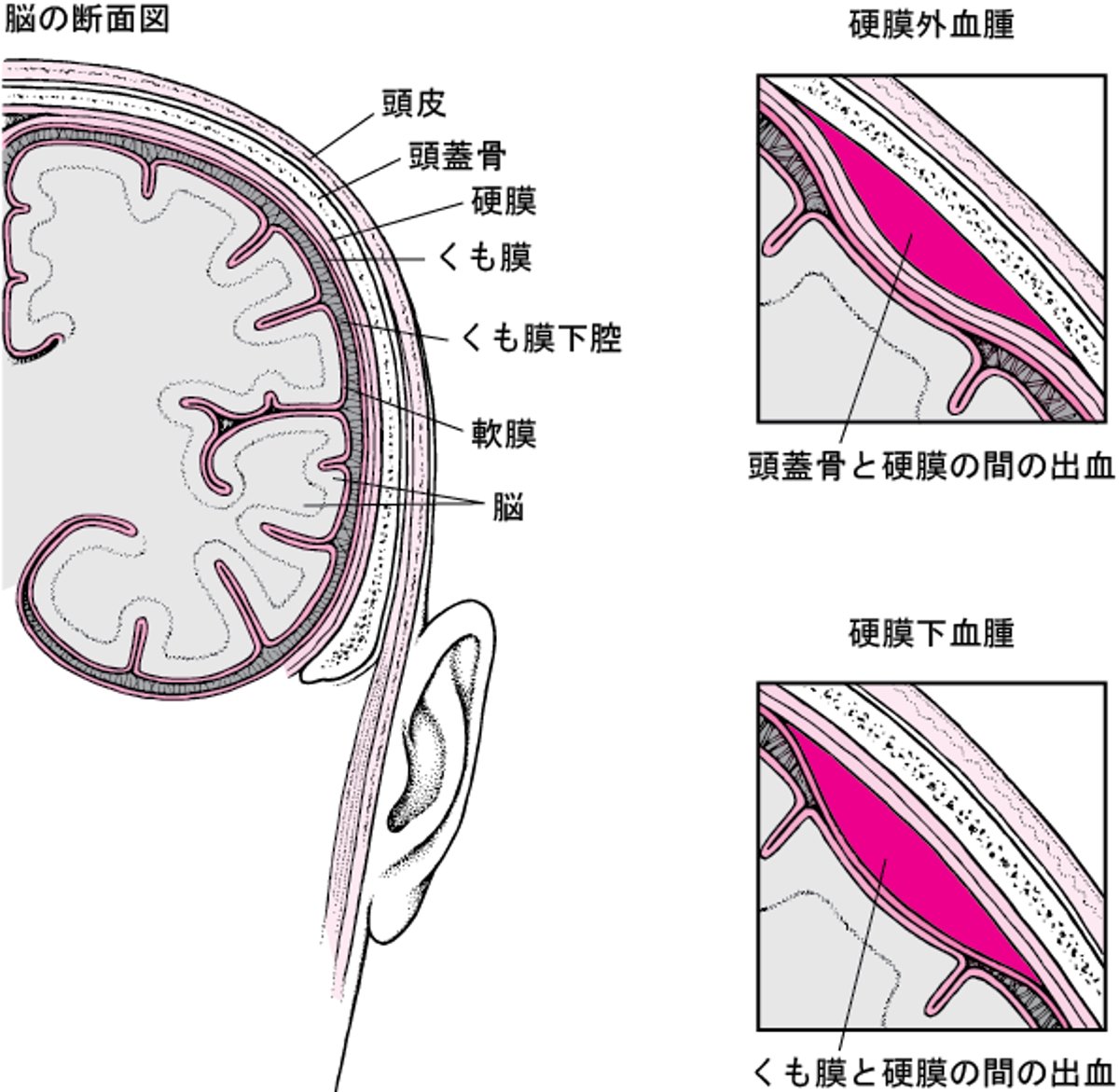 頭蓋内の血腫