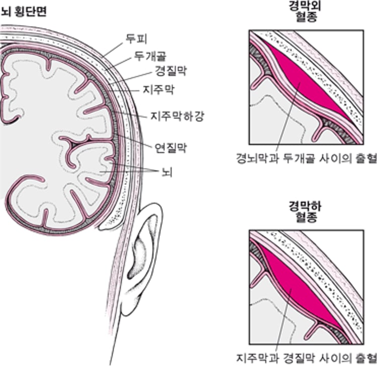 뇌 혈액낭