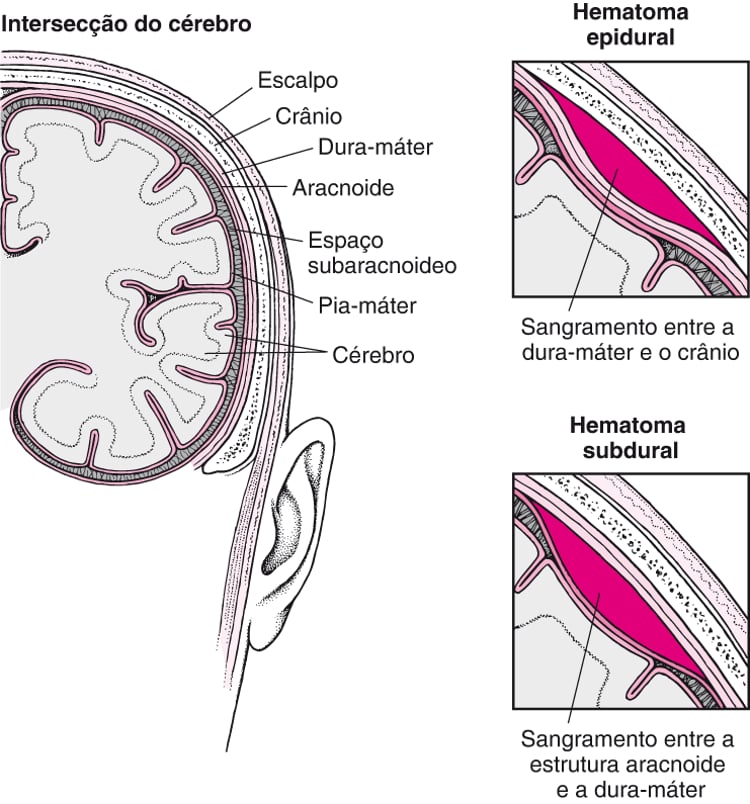 Hematomas intracranianos - Lesões e envenenamentos - Manual MSD Versão ...