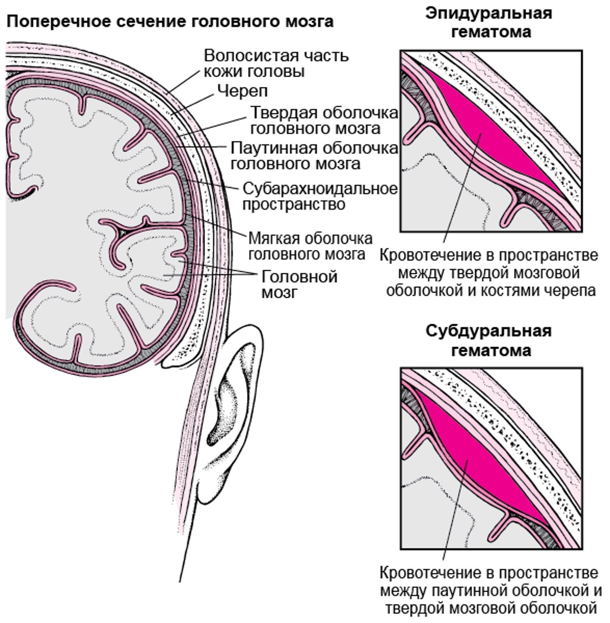 Скопление крови в головном мозге