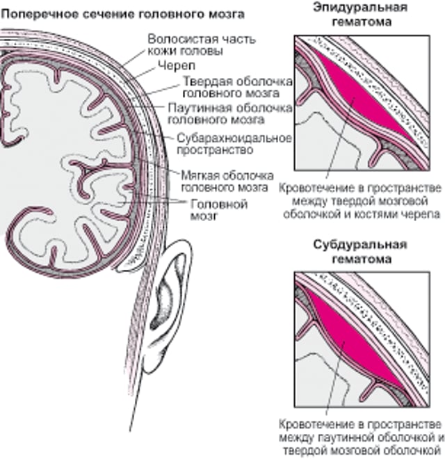 Скопление крови в головном мозге