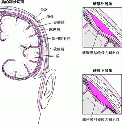 脑出血的腔