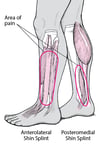 Shin Splints