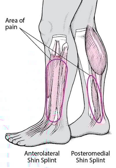 Shin Splints