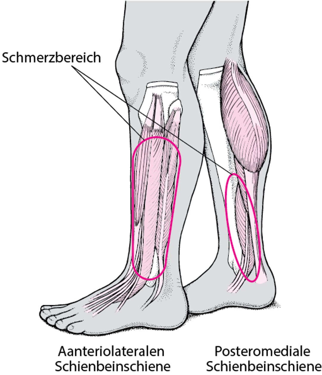 Schienbeinkantensyndrom