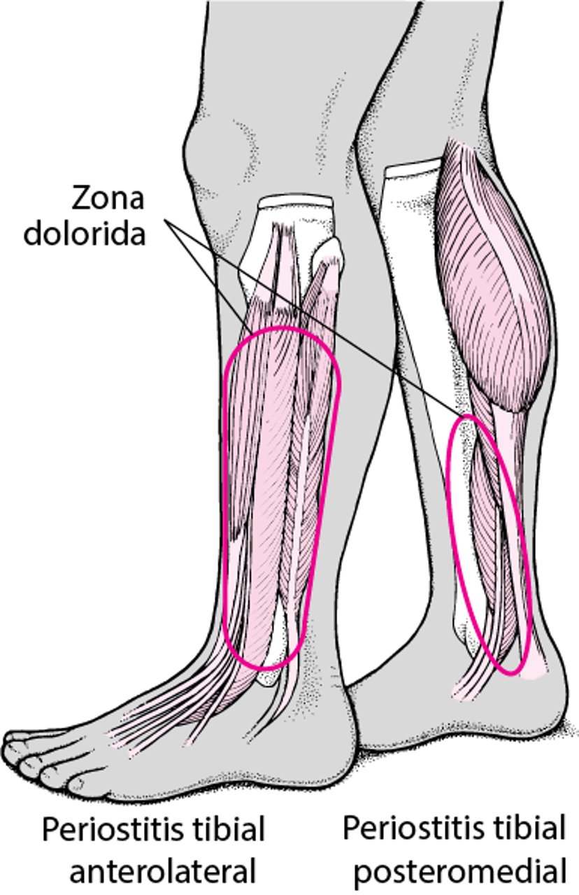 Dolor en las espinillas