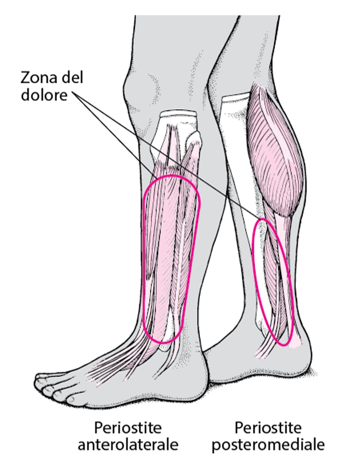 Sindrome da stress tibiale mediale