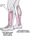 Periostite tibial
