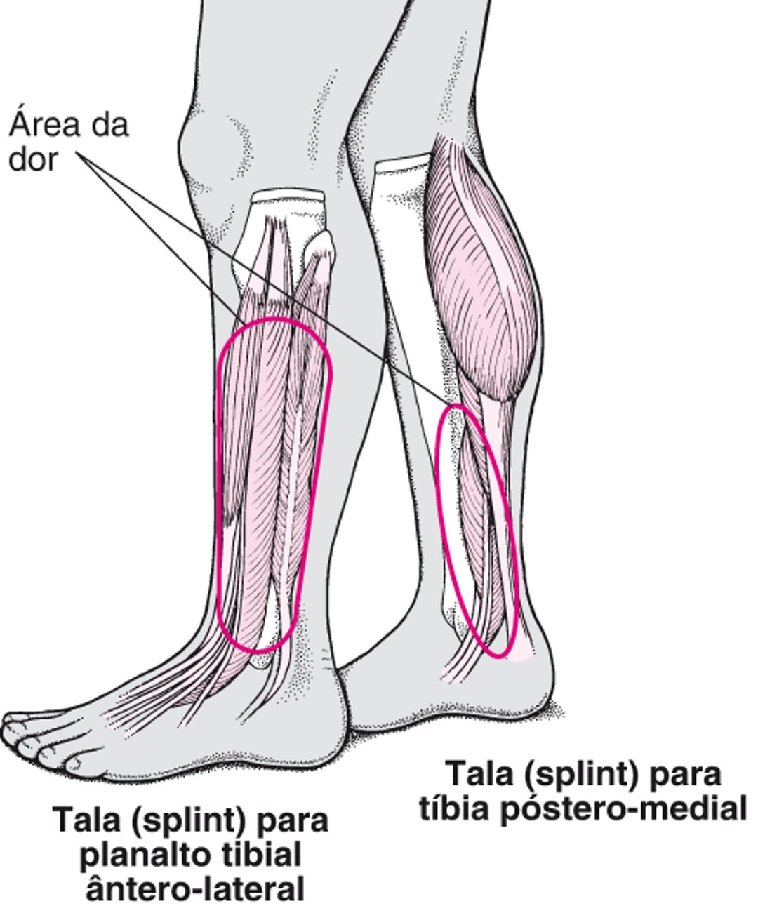 Periostite tibial