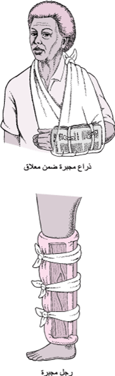 الجبائر الشائعة الاستخدام