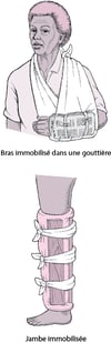Attelles fréquemment utilisées