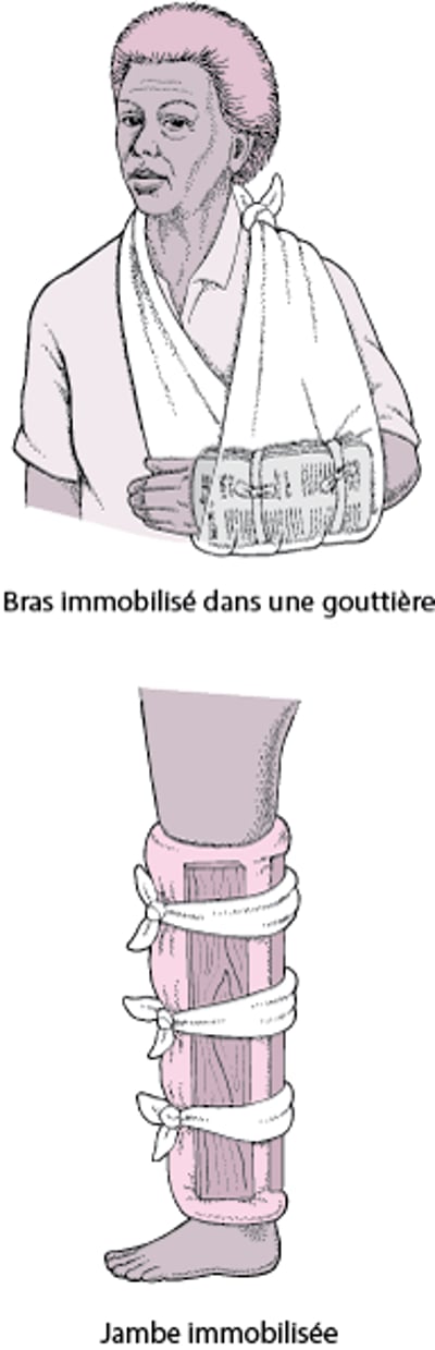 Attelles fréquemment utilisées