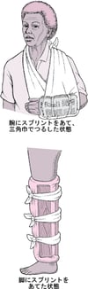 よく使用される副子（固定具）