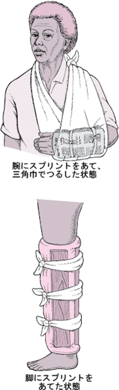 よく使用される副子（固定具）