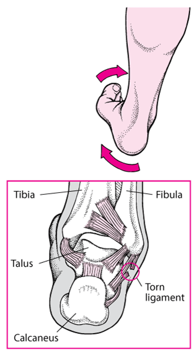 Spraining an Ankle