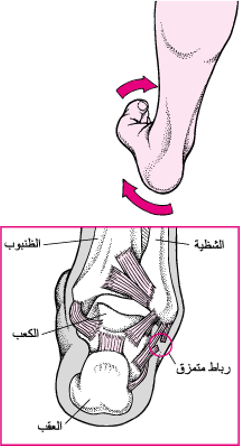 التواءُ أو لوي الكاحل