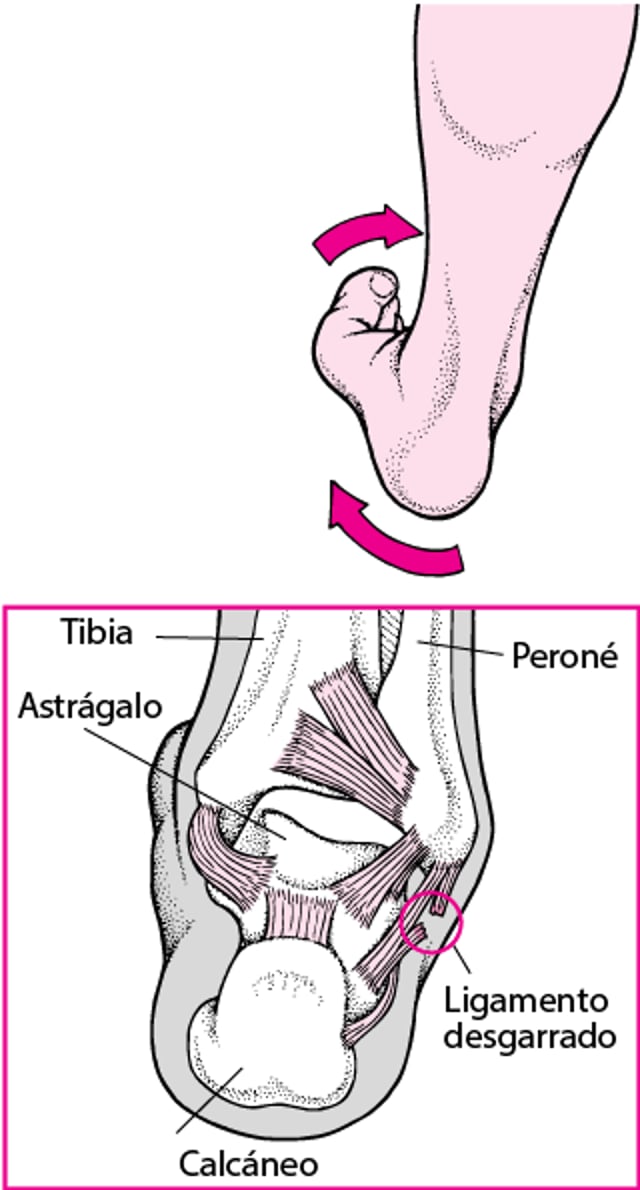 Esguince de tobillo