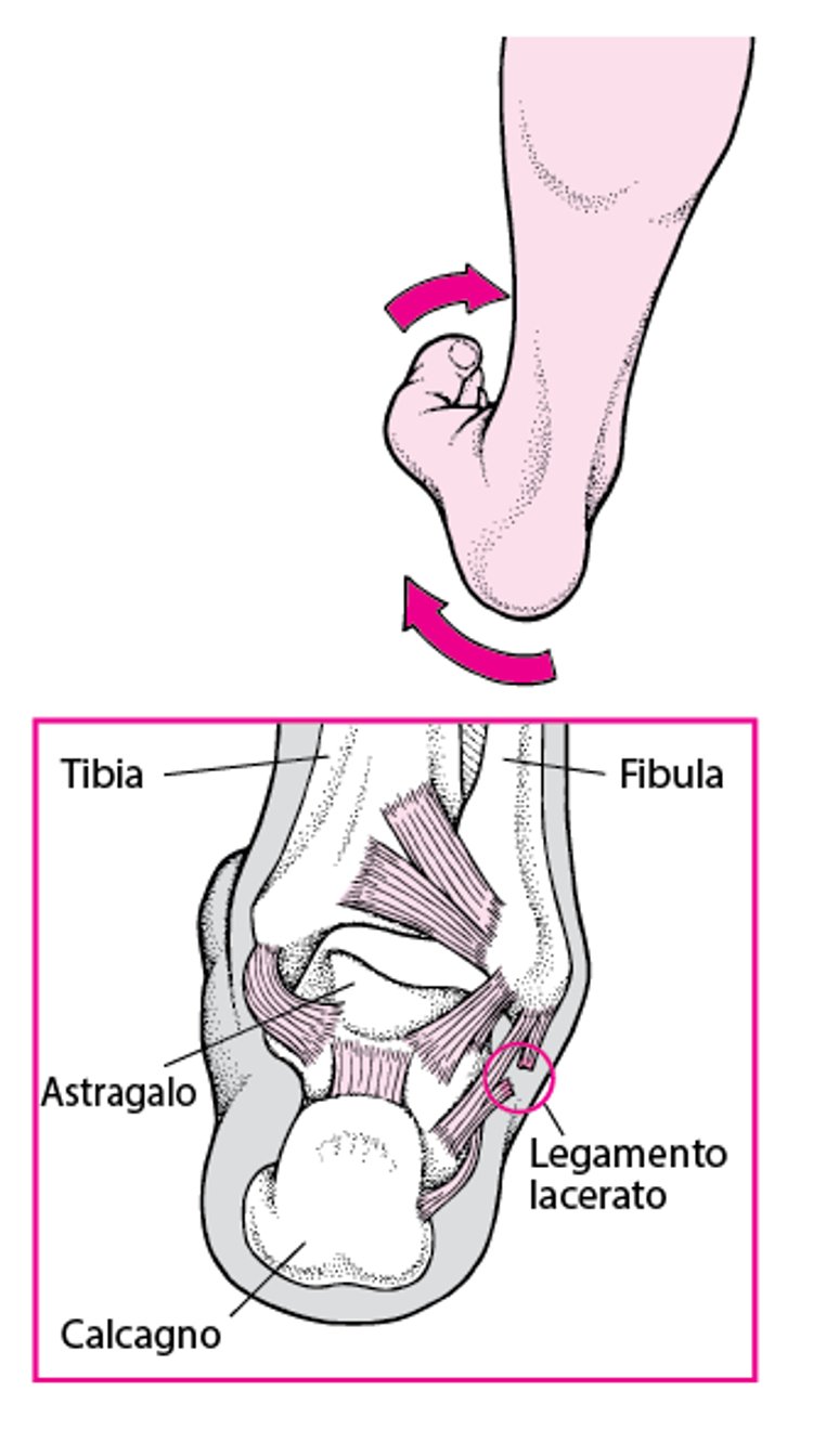 Distorsione della caviglia