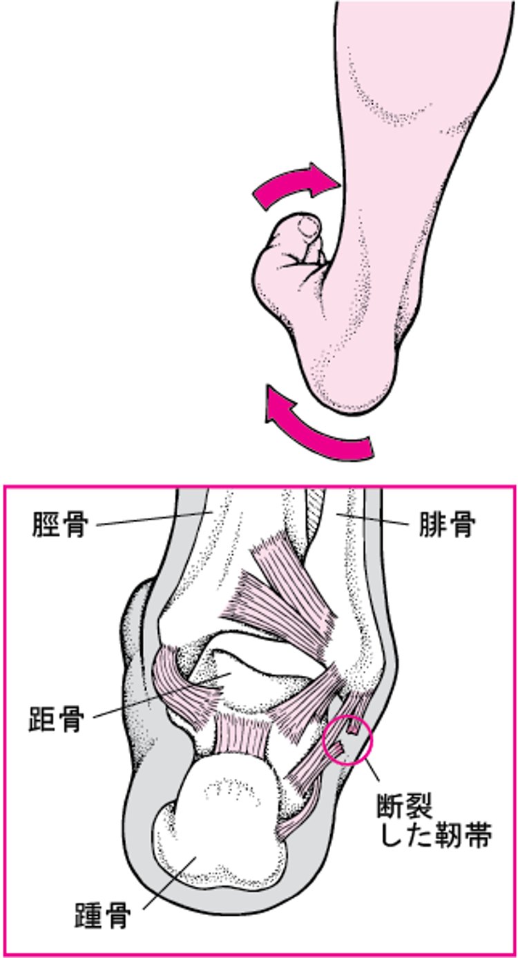 足首のねんざ