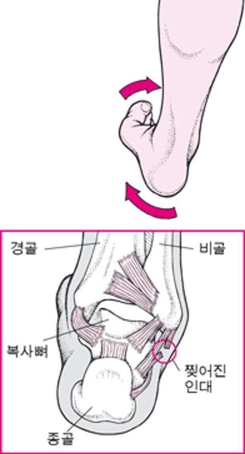 발목 염좌