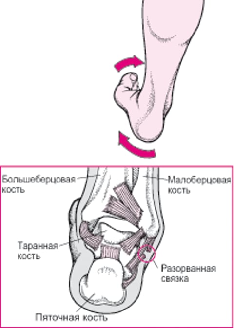 Растяжение лодыжки