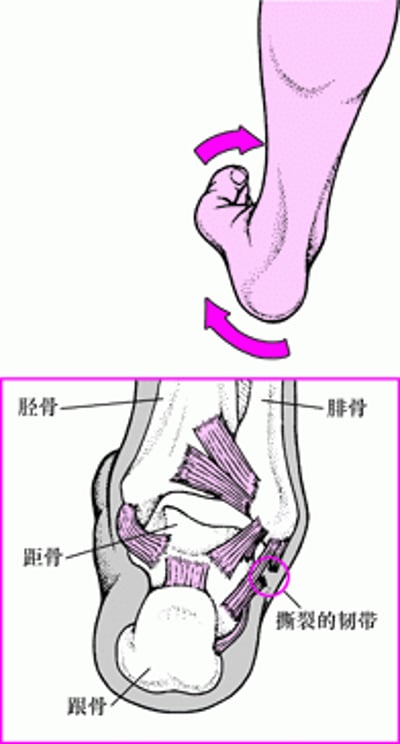 踝关节扭伤