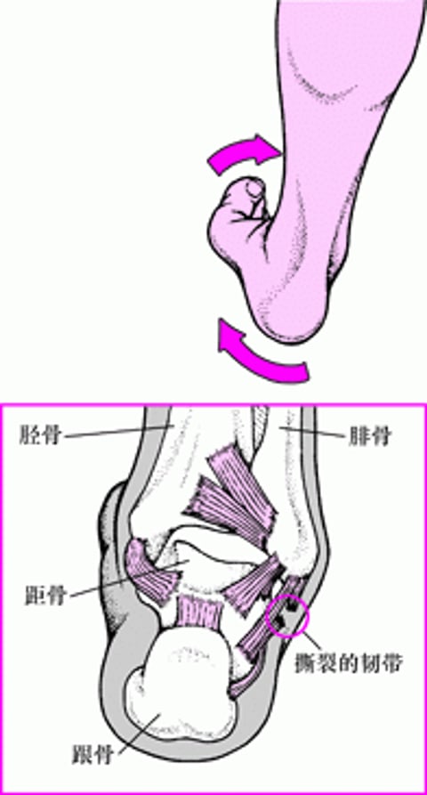 踝关节扭伤