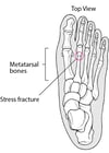 What Is a Stress Fracture?