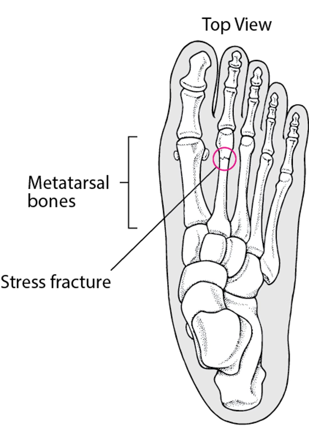 What Is a Stress Fracture?