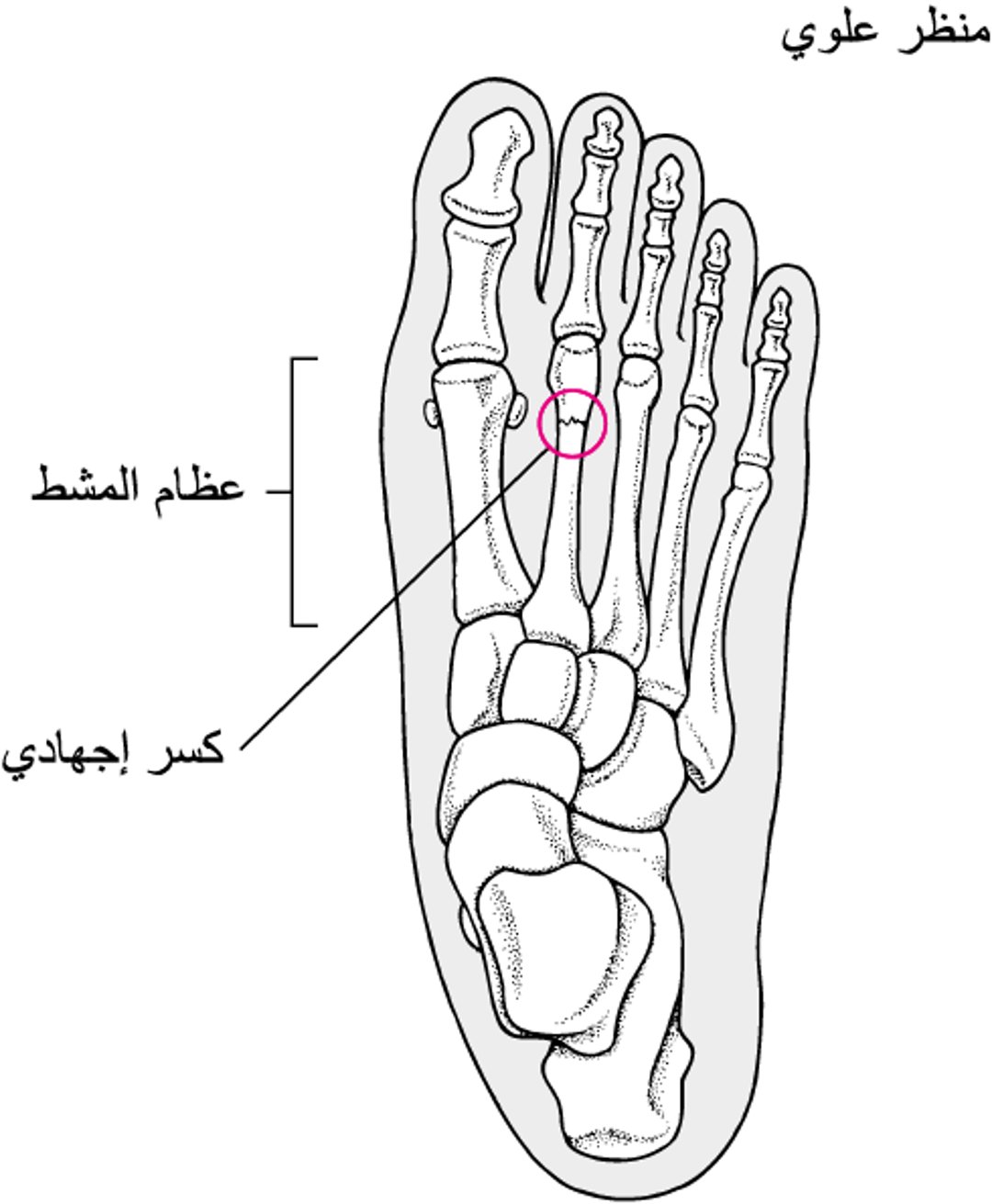 ما هُو كسر الإجهاد؟