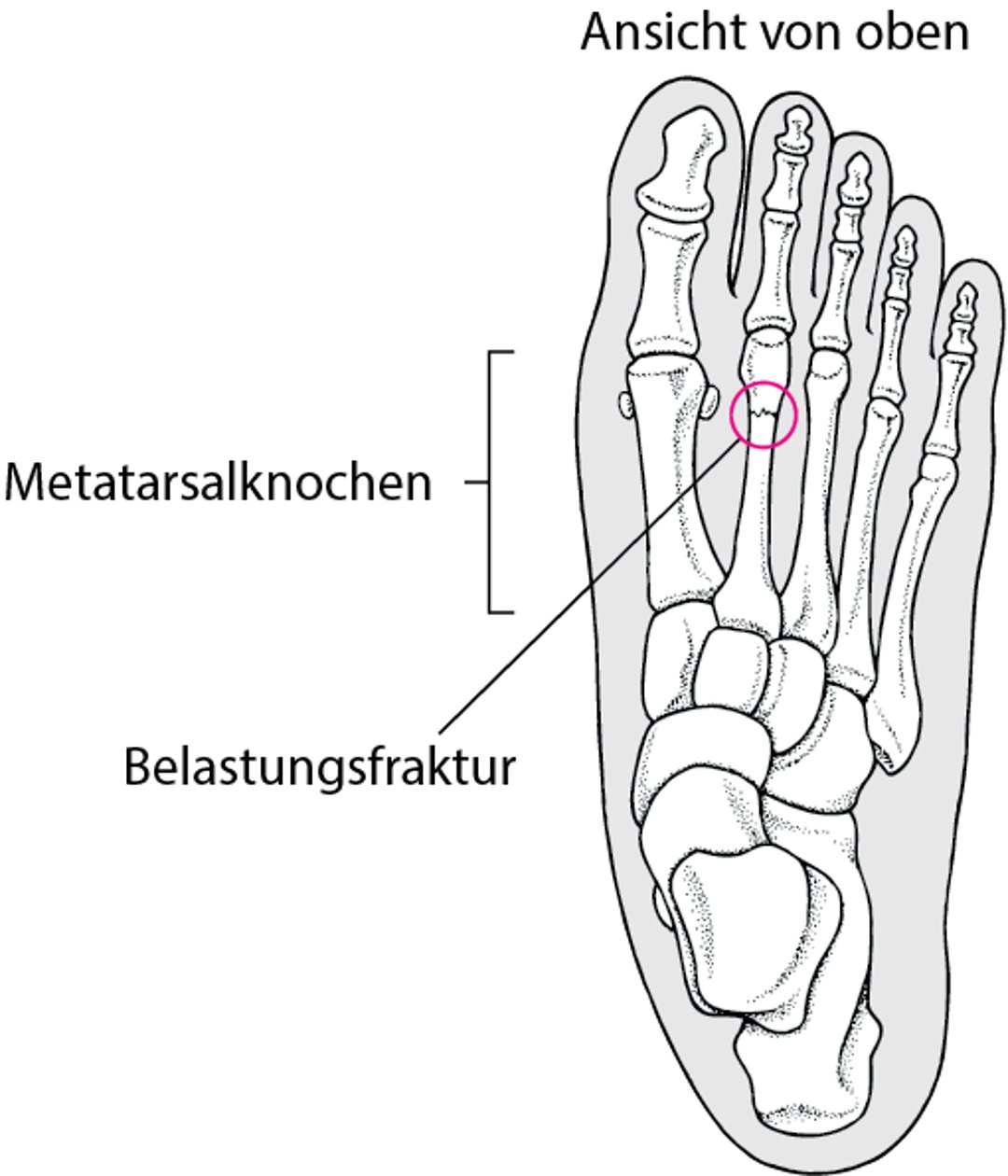 Was ist eine Ermüdungsfraktur?