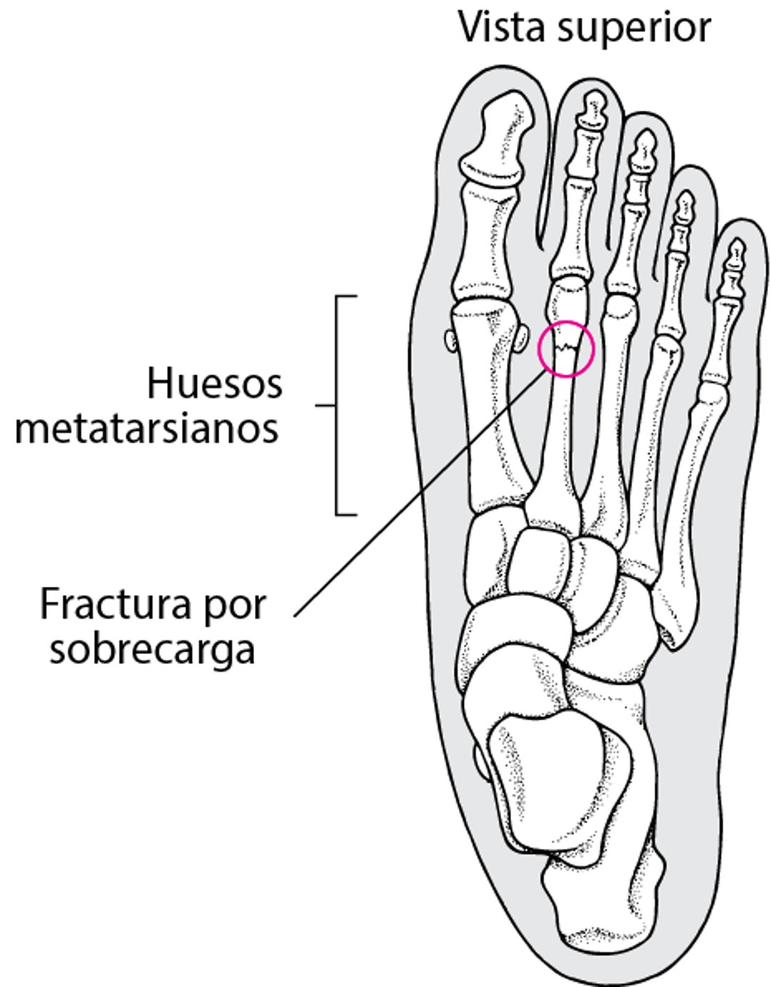 ¿Qué es una fractura por fatiga?