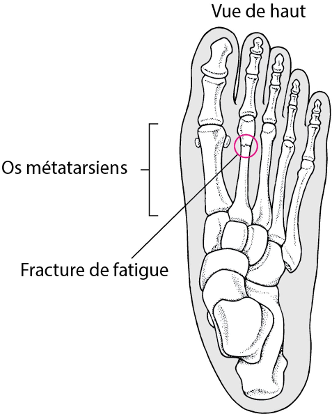 Qu’est-ce qu’une fracture de fatigue ?