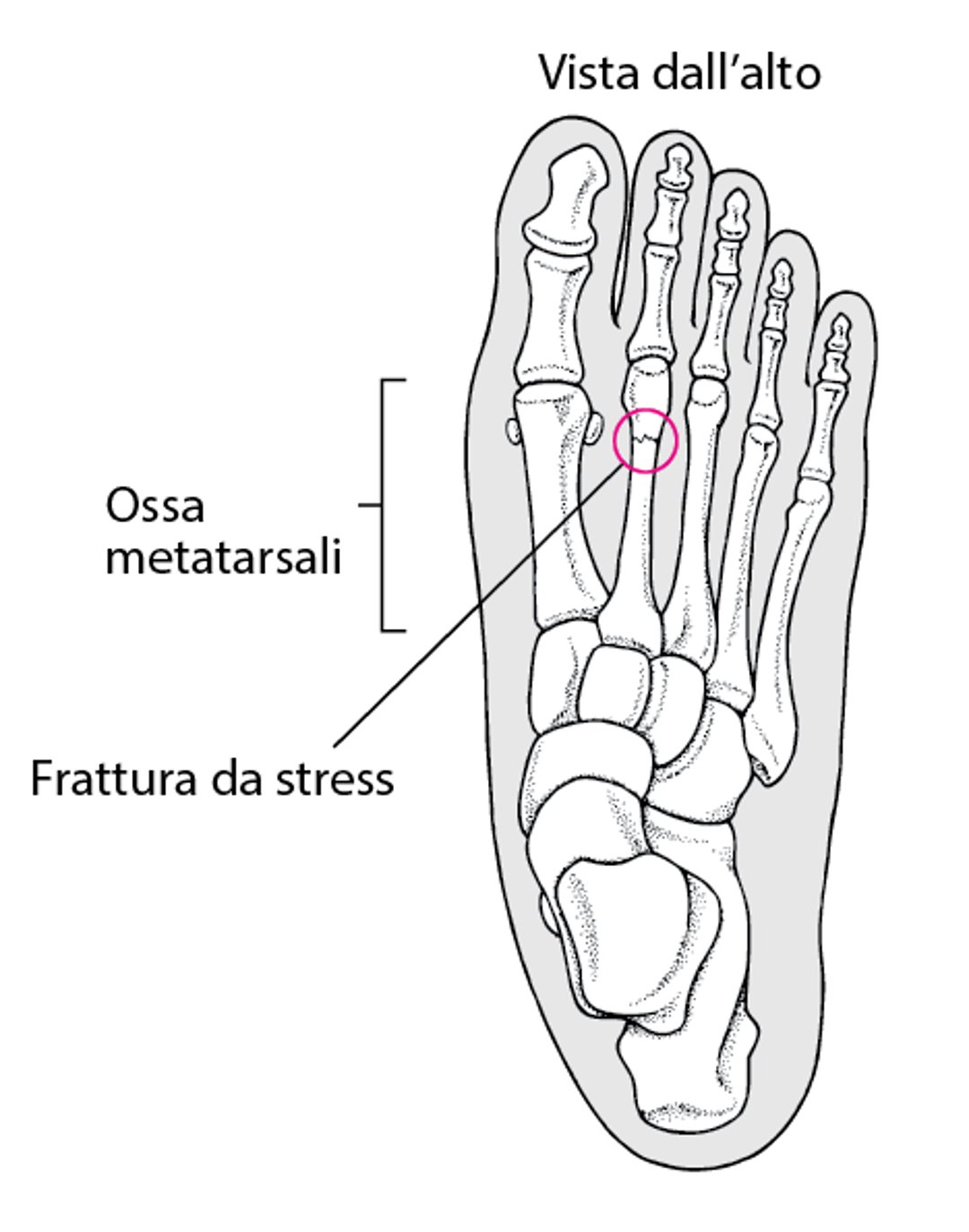 Cos’è una frattura da stress?