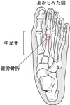 疲労骨折ひろうこっせつとは何なんですか？