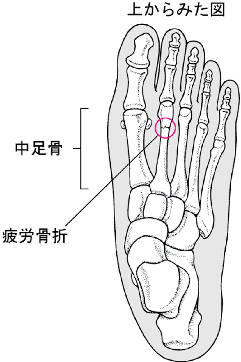 疲労骨折ひろうこっせつとは何なんですか？