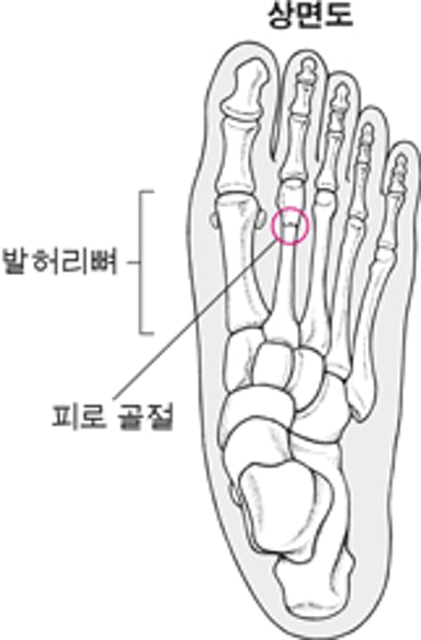 피로 골절이란 무엇입니까?
