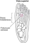 O que é uma fratura por estresse?