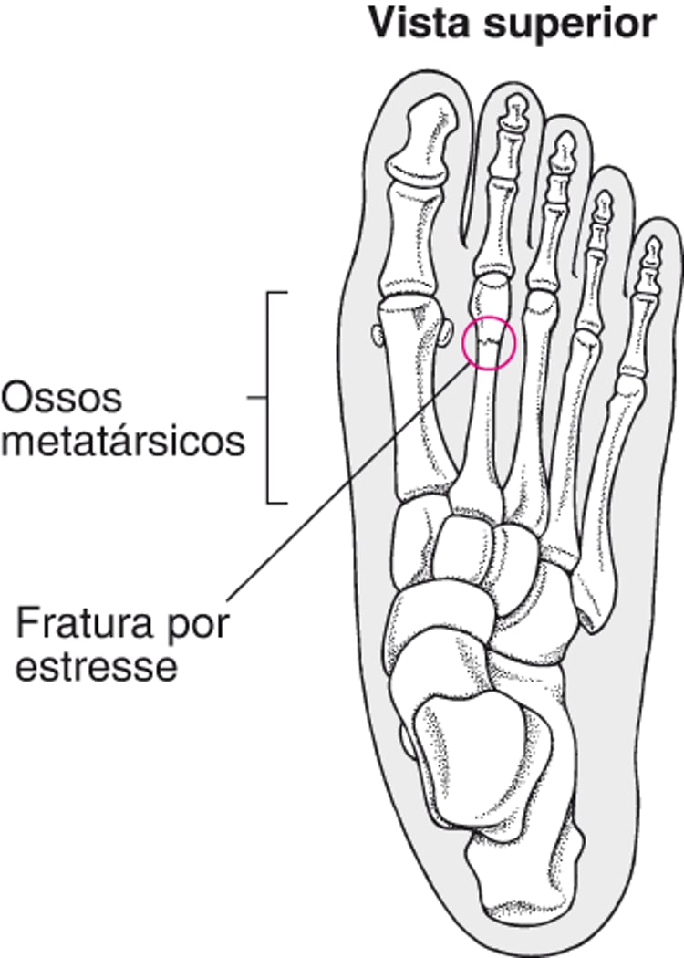 O que é uma fratura por estresse?