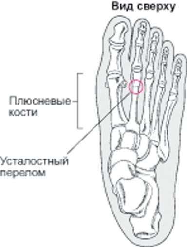 Что такое стрессовый перелом?