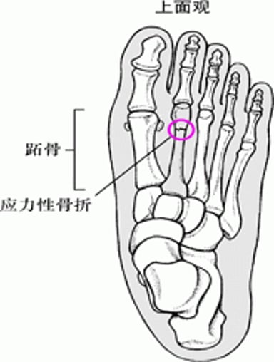 什么是应力性骨折?