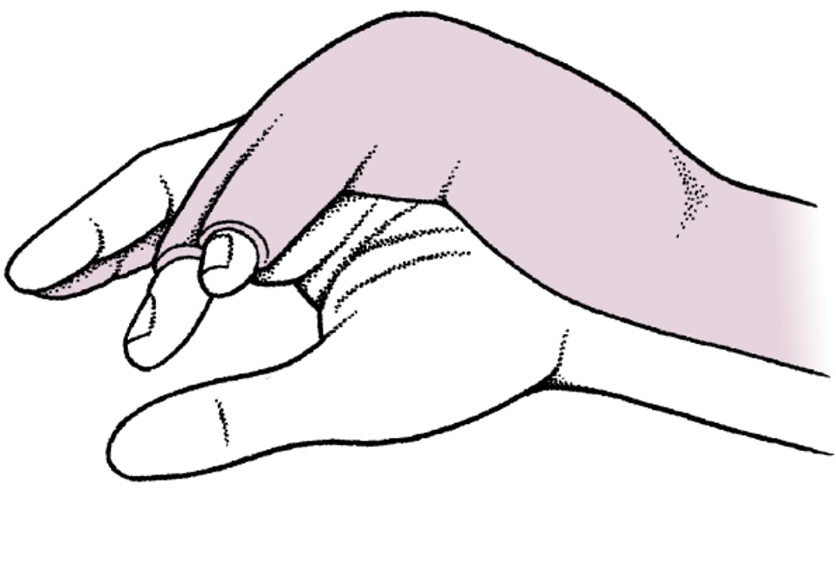 尺骨側の溝状スプリント