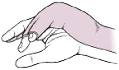 尺骨側の溝状スプリント