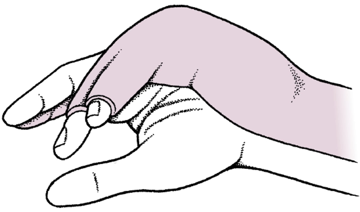 척골 거터 부목