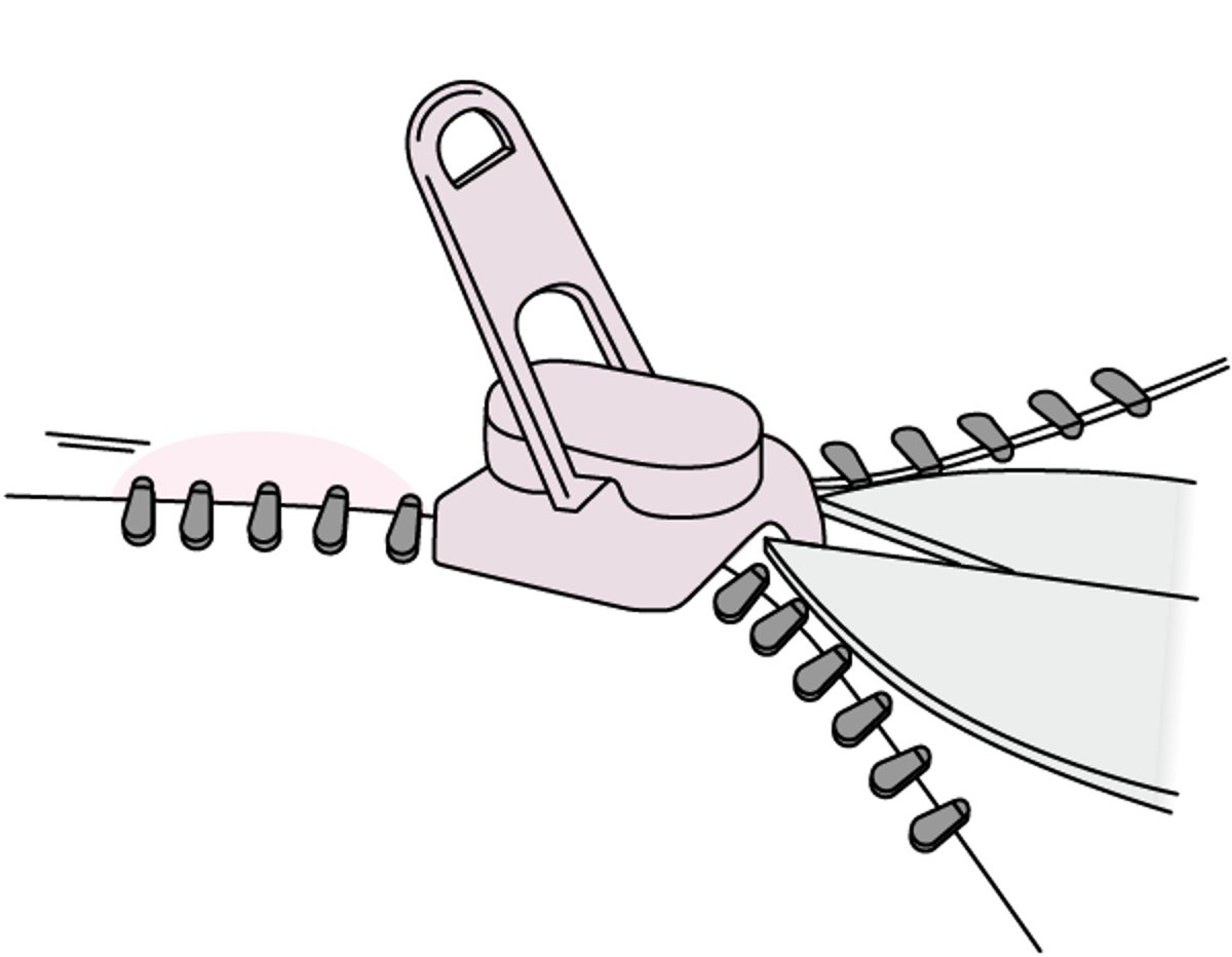 Entfernung der Penishaut vom Reißverschluss