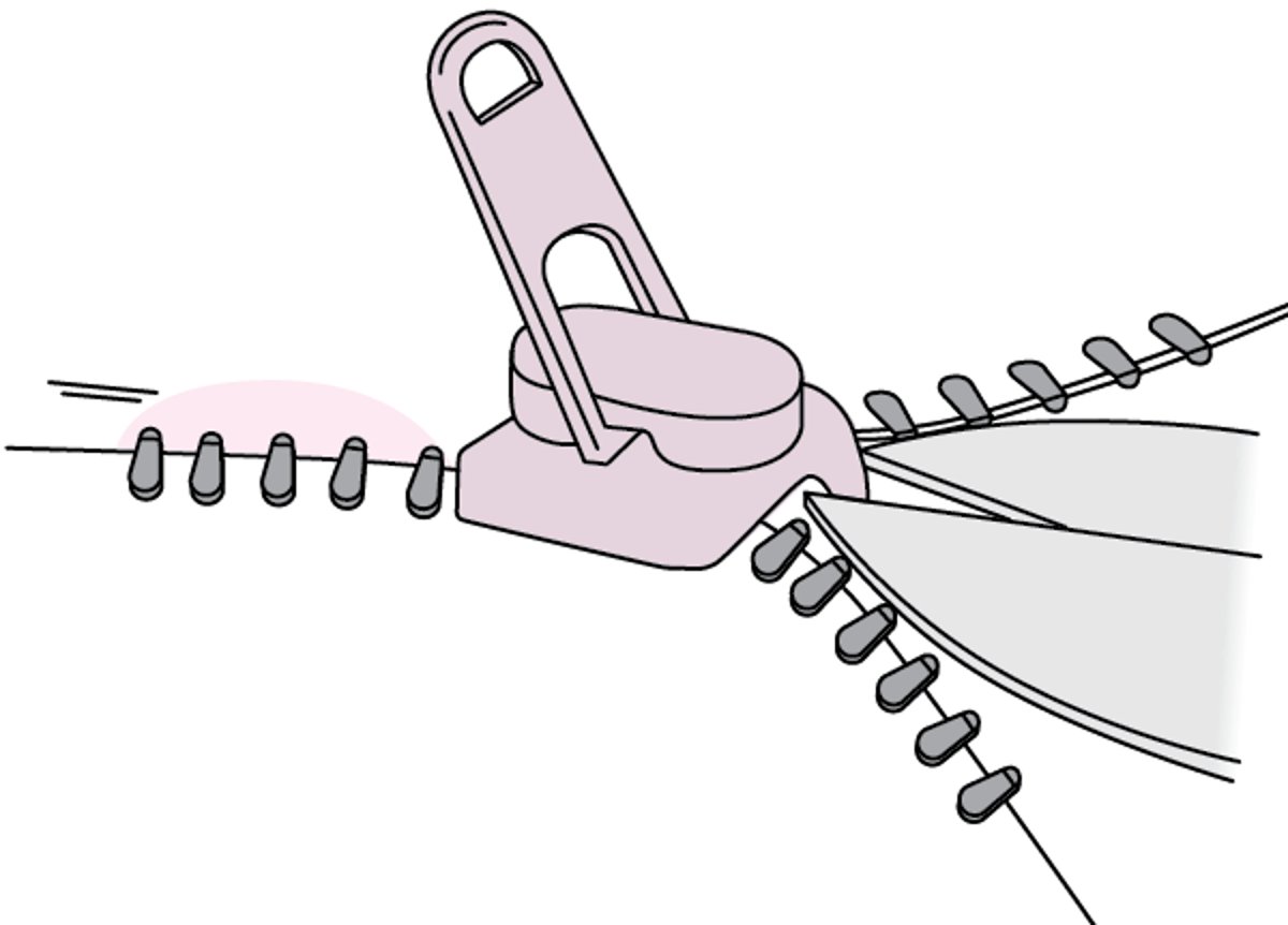 음경 피부에서 지퍼 제거